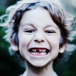 앞니 임플란트 재수술로 본 앞니 임플란트 전문치과의 중요성