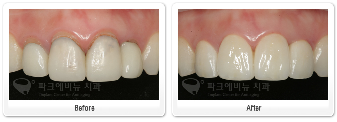 오래된 앞니 보철 교체 사례와 이유