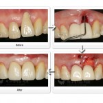 앞니임플란트 재수술 가능할까요? 앞니임플란트 재수술 전문치과