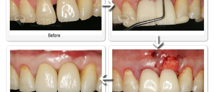 앞니임플란트 재수술 가능할까요?  앞니임플란트 재수술 전문치과