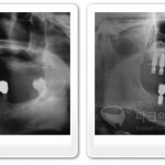 뼈이식 임플란트, 상악동거상술 전문 강남수면치과