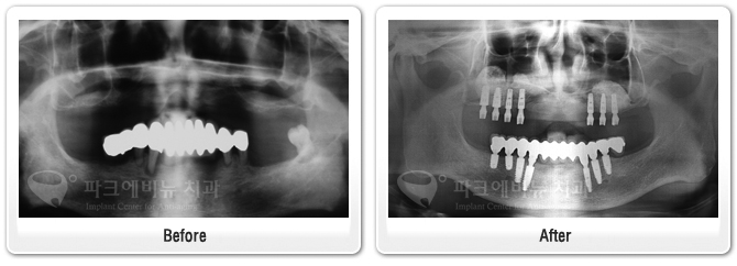 뼈이식 임플란트, 상악동거상술 전문 강남수면치과