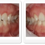 라미네이트, 치아성형 이제 자신있게 웃으세요