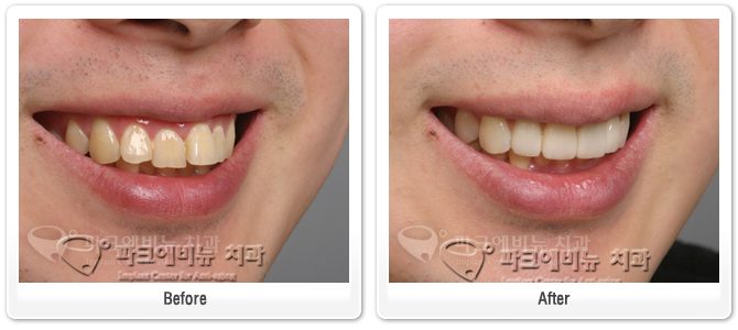 삐뚤빼뚤한 앞니, 교정 없이도 가지런하게? — 라미네이트·크라운·레이저 잇몸성형술로 만드는 전치부 심미 치료