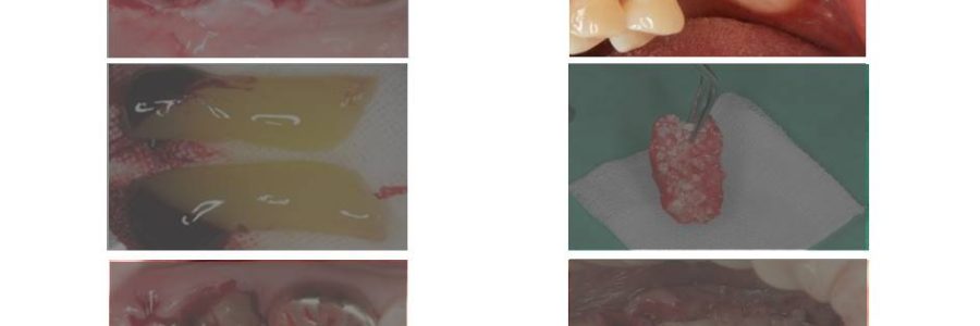 [언주역치과, 논현동치과, 강남치과 추천] 🩸🦷 PRF가 뭐길래 넣는다는 걸까요? 내 피로 만드는 재생 치료