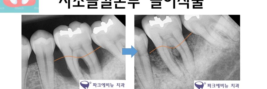 [언주역치과, 논현동치과, 강남치과 추천] 🦴🦷 임플란트 하려는데 뼈가 부족하다고요? 골이식의 종류와 과정