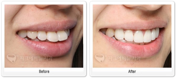 [언주역치과, 논현동치과, 강남치과 추천] ✨🦷 돌출된 앞니, 깨진 치아, 변색까지 – 라미네이트·올세라믹 크라운으로 달라진 미소 (치료 전후)